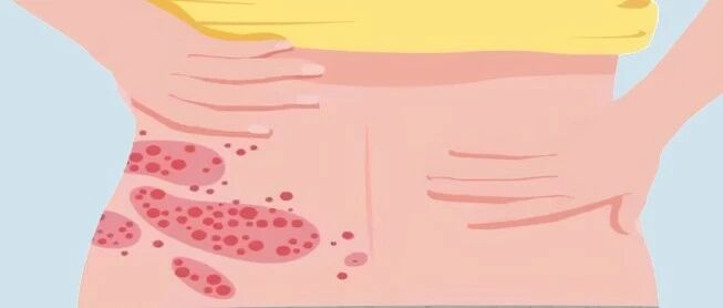 一文带你认识治疗带状疱疹的药物