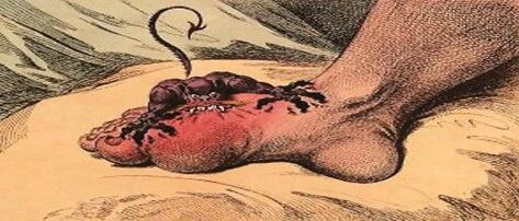 痛风的真相：严格忌口，尿酸为什么不降反升？