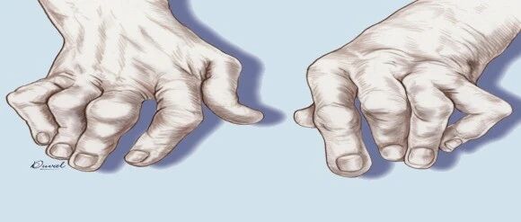 为什么痛风病人越来越年轻？尿酸高就是痛风吗？关于痛风的六大问题！