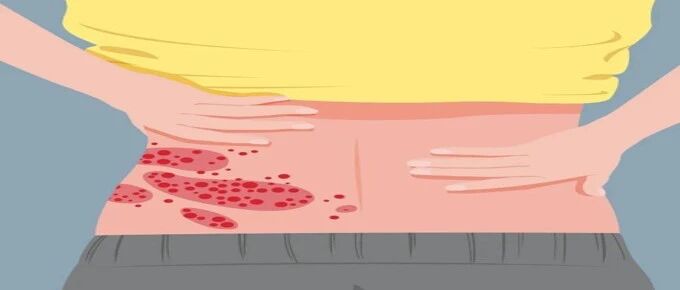 一文带你认识治疗带状疱疹的药物！