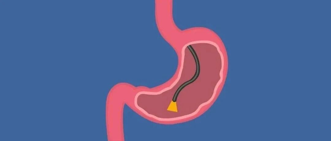 慢性萎缩性胃炎6大用药方案，一文掌握！