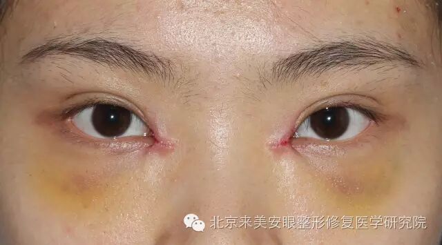 内眼角修复# 案例 2016年7月16日e顾客 术前—术后1个月对比 -王振 