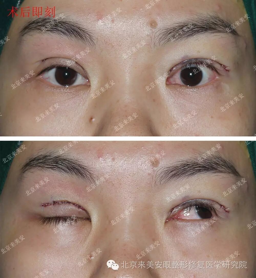 黑眼球,为保护眼睛,手术结束到术后5天拆线前左眼全天均需涂抹眼膏,并