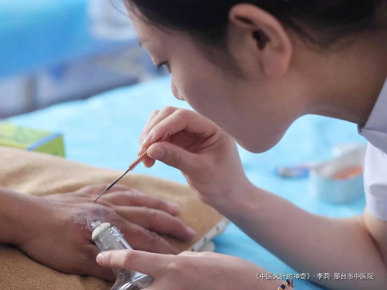 《中医火针的神奇》-李莉-邢台市中医院