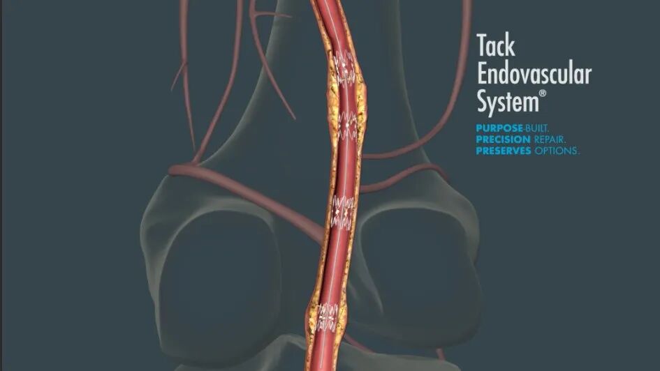 (Philips)飛利浦3.6億美金收購Intact Vascular：擴大外周產(chǎn)線，挑戰(zhàn)介入格局