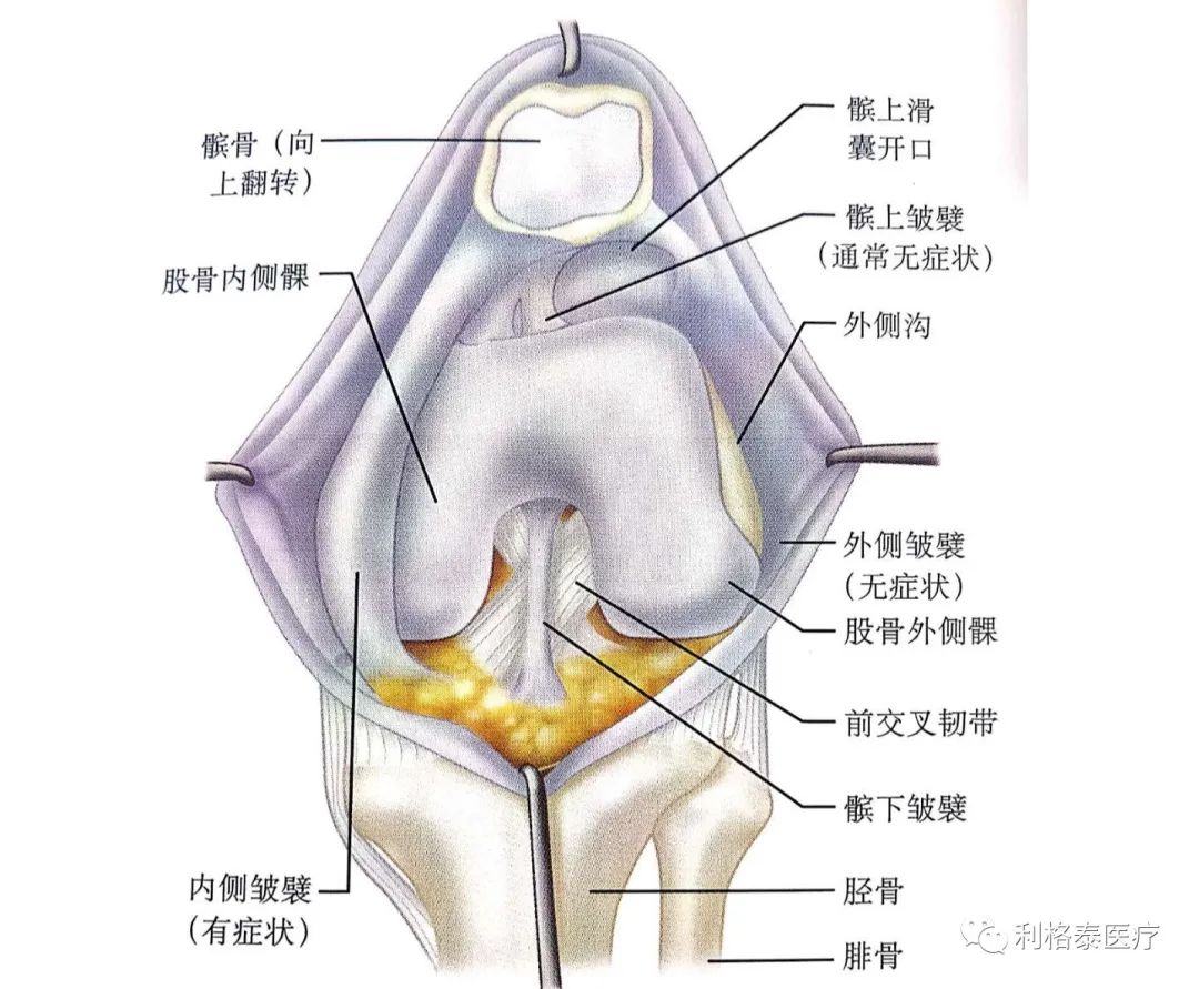 膝关节滑膜皱襞的诊断与治疗详解