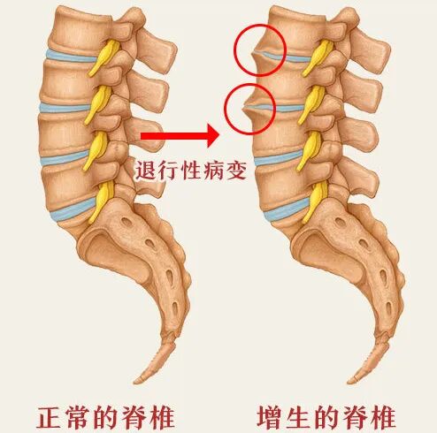 跛行可能会导致脊柱前倾,让腰椎部位长时间处于不正确的姿势中,造成