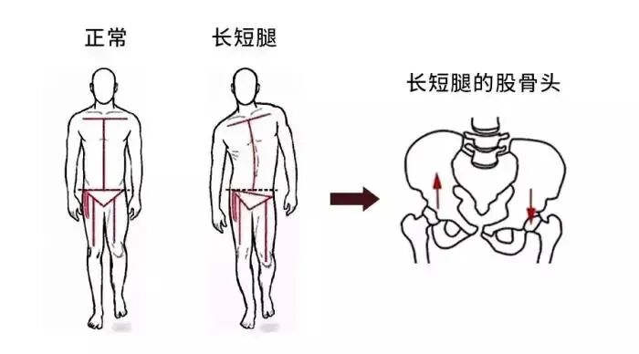 骨盆倾斜后,会进一步加剧跛行情况,同时会对周围的神经造成压迫,引起