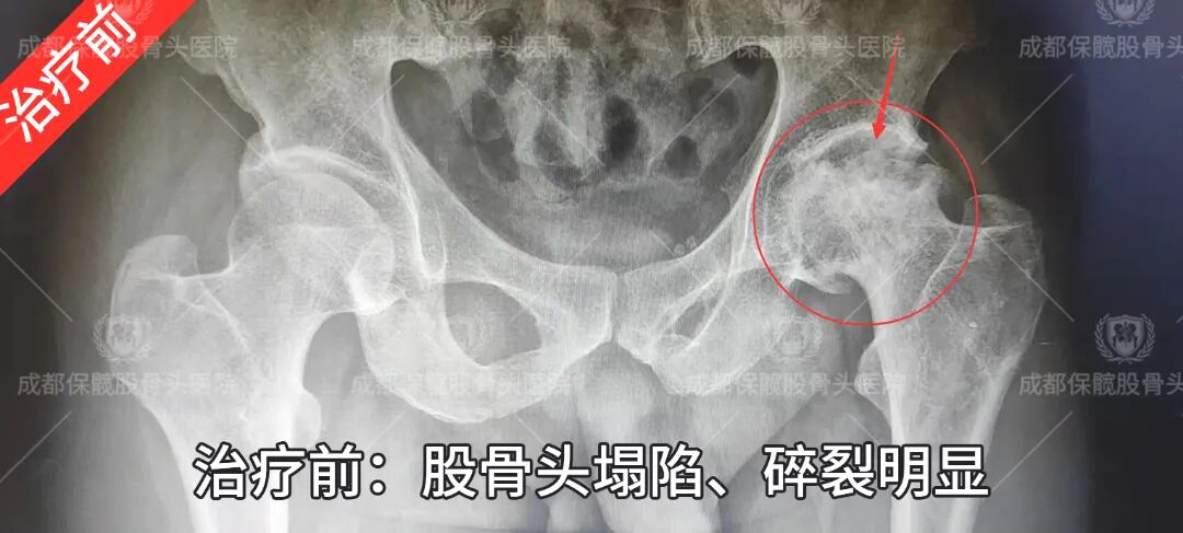 谁说股骨头塌陷了就只能换关节