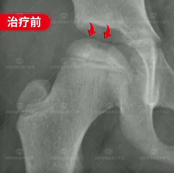 谁说股骨头塌陷了就只能换关节