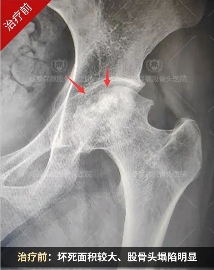 35岁,左侧股骨头坏死,来院时疼痛很严重,有明显塌陷,通过系统保髋治疗