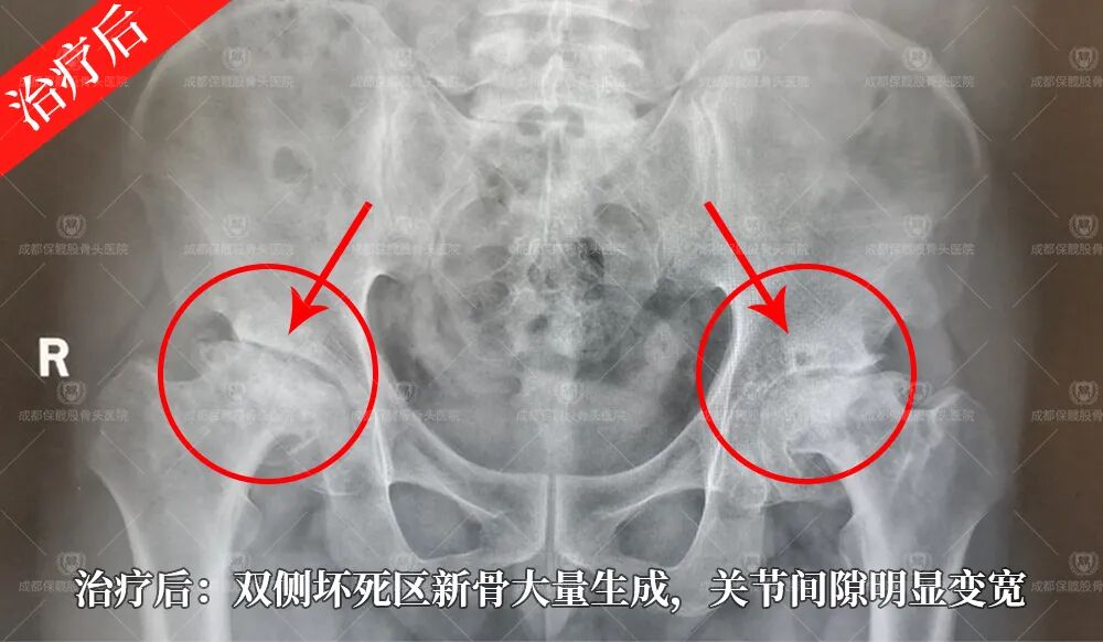 谁说股骨头塌陷了就只能换关节