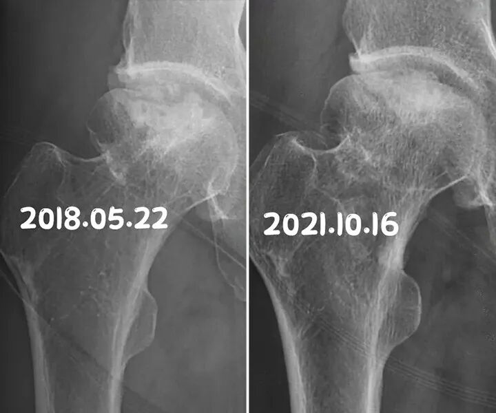 谁说股骨头塌陷了就只能换关节