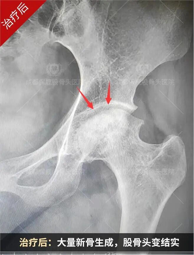 谁说股骨头塌陷了就只能换关节