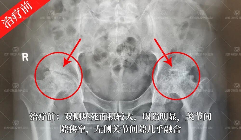 谁说股骨头塌陷了就只能换关节