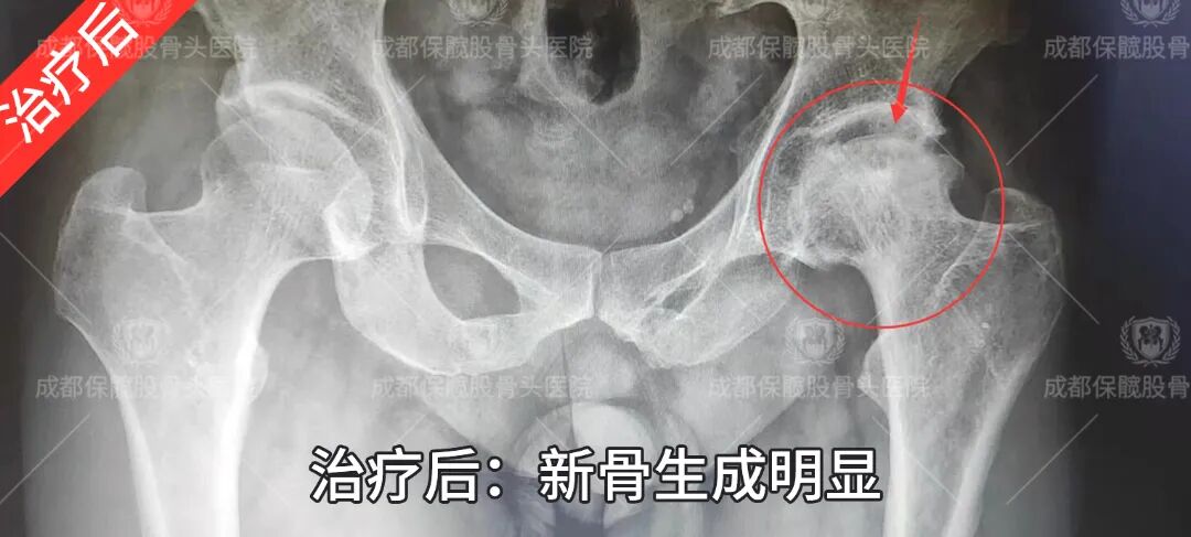 谁说股骨头塌陷了就只能换关节