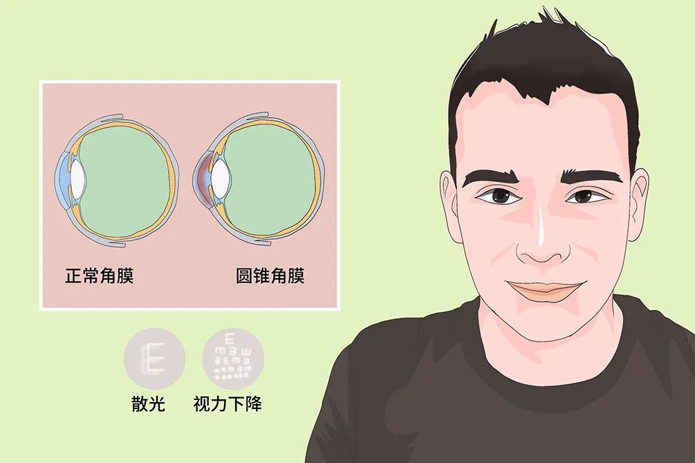 角膜曲率和近视有什么关系？为什么验配角膜塑形镜时需要注意角膜曲率呢？