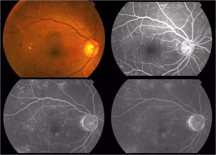眼底出血造影图片图片