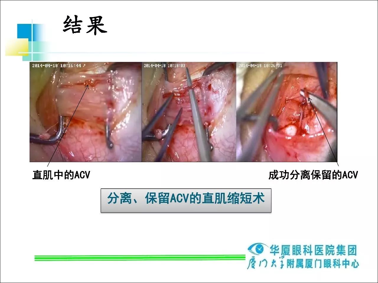 斜视手术肌肉缝合图解图片