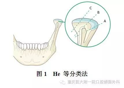 国际进展下颌骨髁突骨折的手术治疗现状