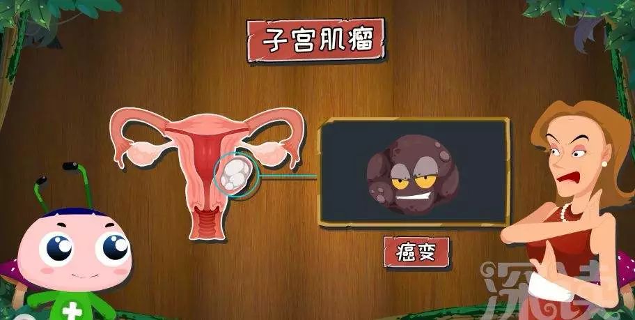 子宫肌瘤专挑这3种女人下手！越早灸疗，越早远离！