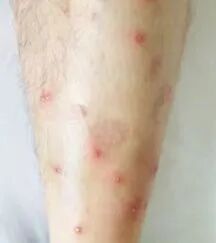 那些“千奇百怪”的虫咬皮炎