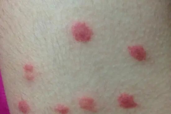 那些“千奇百怪”的虫咬皮炎