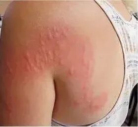 那些“千奇百怪”的虫咬皮炎