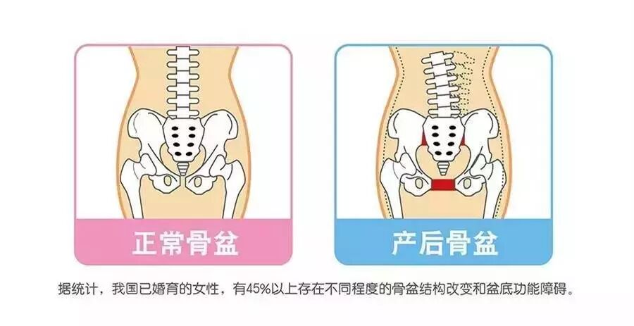 不做骨盆修复会有什么危害？