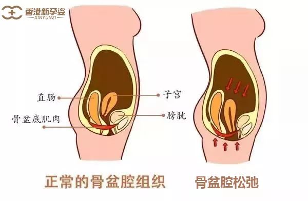 【产后康复】女人，一定要守护好你的下半身！