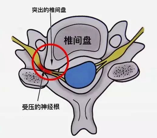 颈椎间盘图片 位置图图片