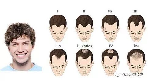 极易导致脱发的各类病因 深圳精微植发 微信公众号文章阅读 Wemp