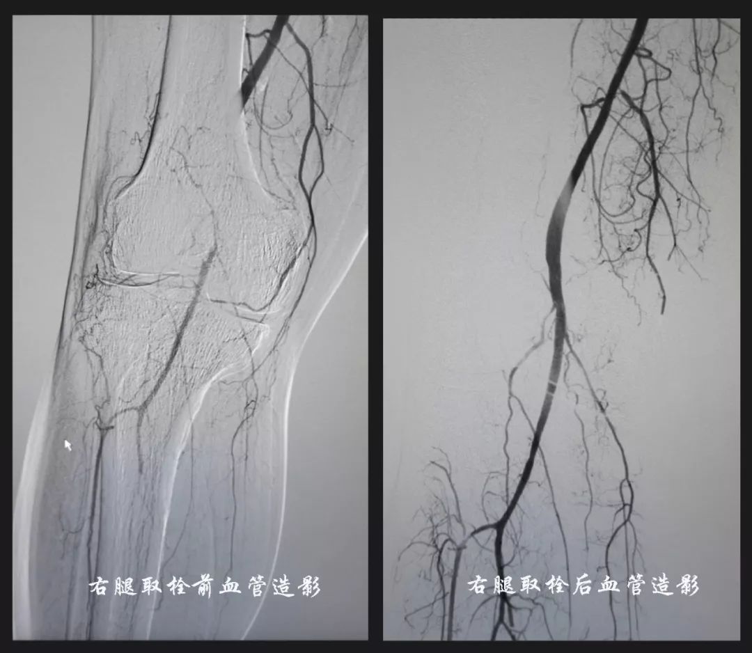 老汉突然两腿发凉疼痛 医生竟从他的双腿血管内取出长长两条 平湖一院 微信公众号文章阅读 Wemp