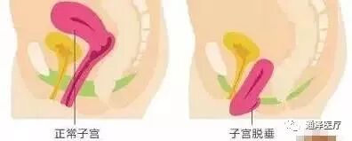 盆腔脏器脱垂青睐人群，你在里面吗？|产康资讯-广州通泽医疗科技有限公司