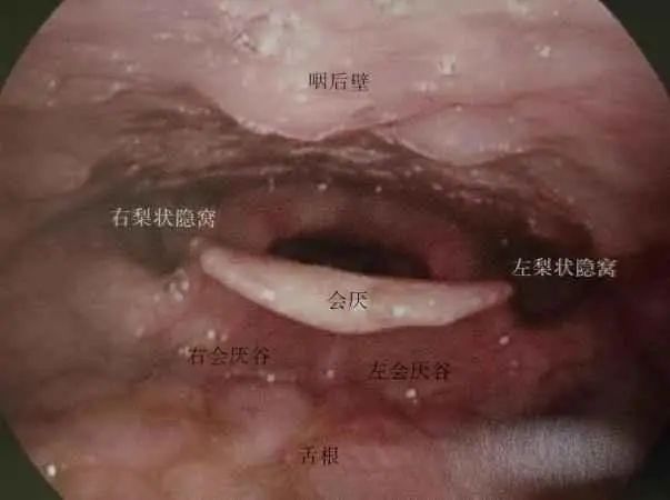 【健康科普】喉镜吞咽功能检查