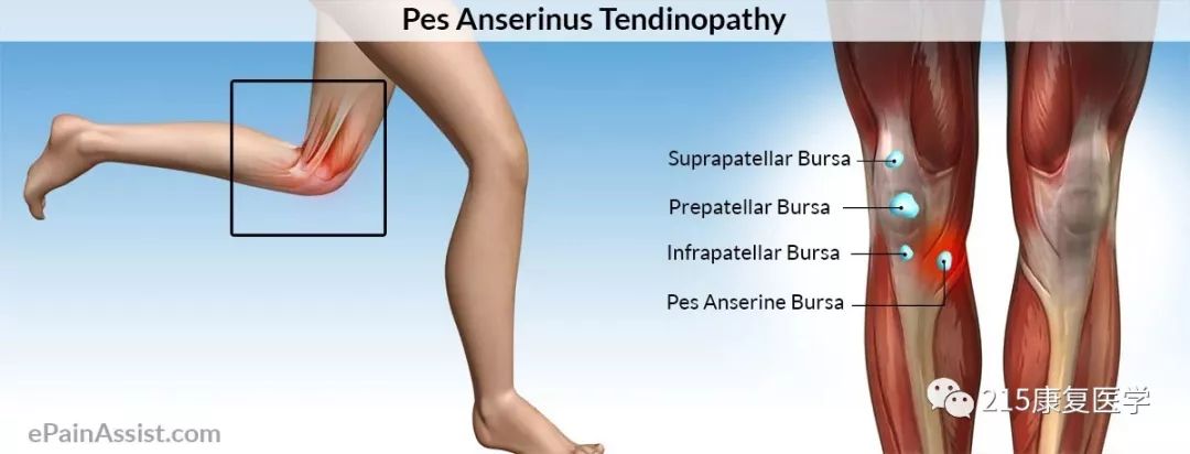 不明内侧膝痛 鹅足肌腱炎及滑囊炎 215康复医学 微信公众号文章阅读 Wemp