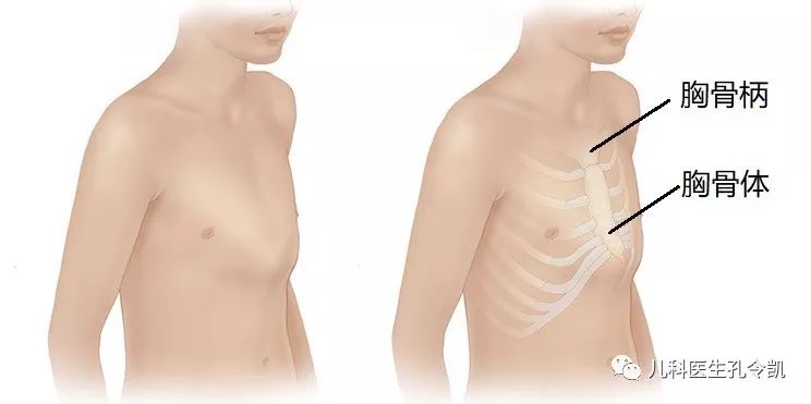 鸡胸漏斗胸 补钙能纠正吗 儿科医生孔令凯 微信公众号文章