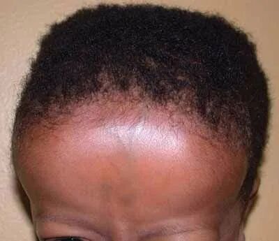 怎么看宝宝头大不大是不是佝偻病的方颅