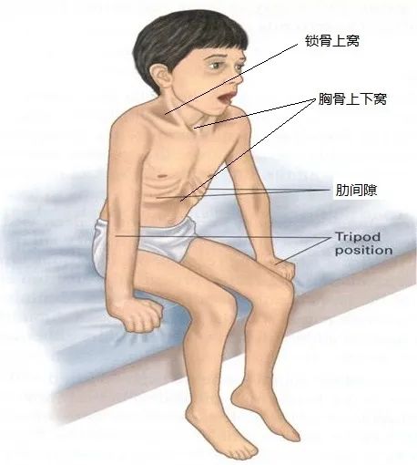 上图是三凹征上图是点头呼吸第三是循环异常时的皮肤表现。出现苍白、皮