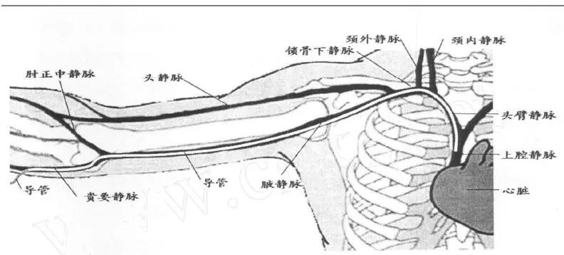 脐静脉导管尖端位置图片