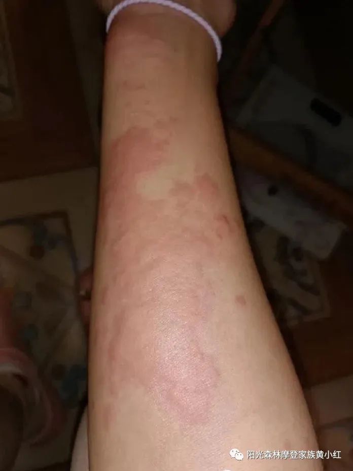 哺乳期严重荨麻疹一个星期修复