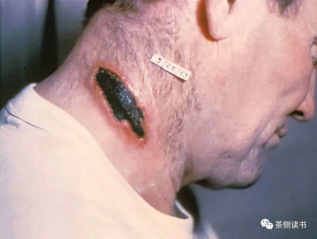 细菌战伤口80年未好,浙江丽水细菌战，有人几十年后才知道，自己的烂脚源于战争