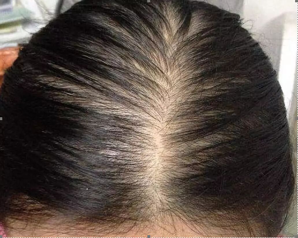 女性脱发问题如何解决？
