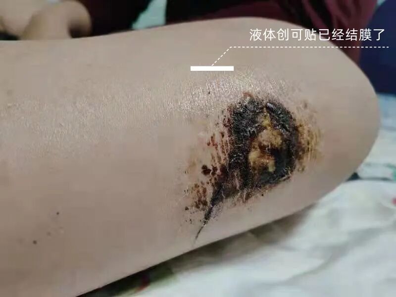 医院DR怎么消毒液体创可贴：促进湿性愈合，消毒防护，有娃必备！_https://www.jmylbn.com_新闻资讯_第17张