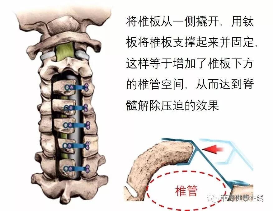 脊髓型颈椎病 最严重 致残率最高的颈椎病 菲哥健康在线 微信公众号文章阅读 Wemp