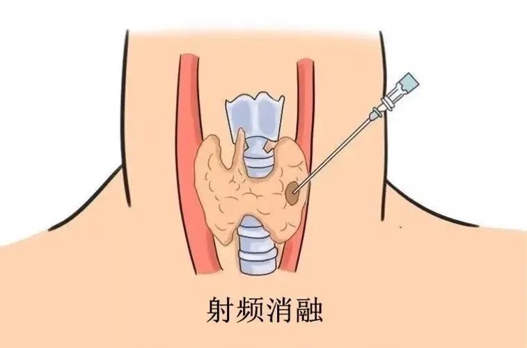 微波针是什么“针尖”上的手术： 微波消融术治疗甲状腺疾病_https://www.jmylbn.com_新闻资讯_第3张
