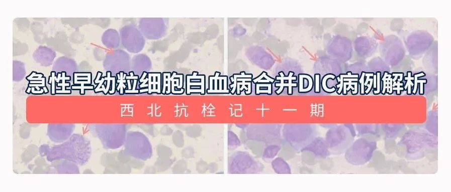 急性早幼粒细胞白血病（AML-M3）合并DIC病例 | 西北抗栓记十一期