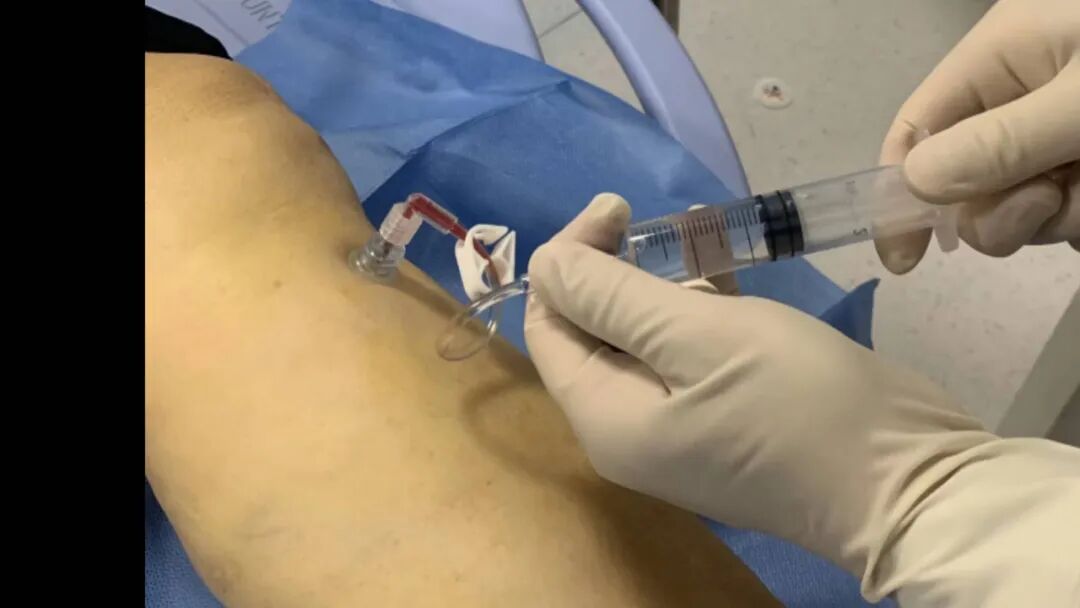 骨髓腔穿刺置管输液技术为患者打通另一条生命通道_城事生活_平顶山