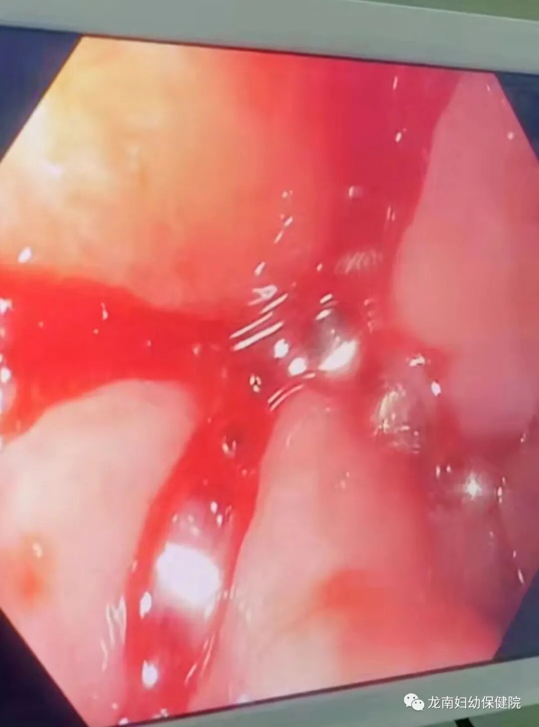 内镜夹怎么不掉【胃镜室病例】贲门出血“夹”然而止，消化内镜显神通_https://www.jmylbn.com_新闻资讯_第9张