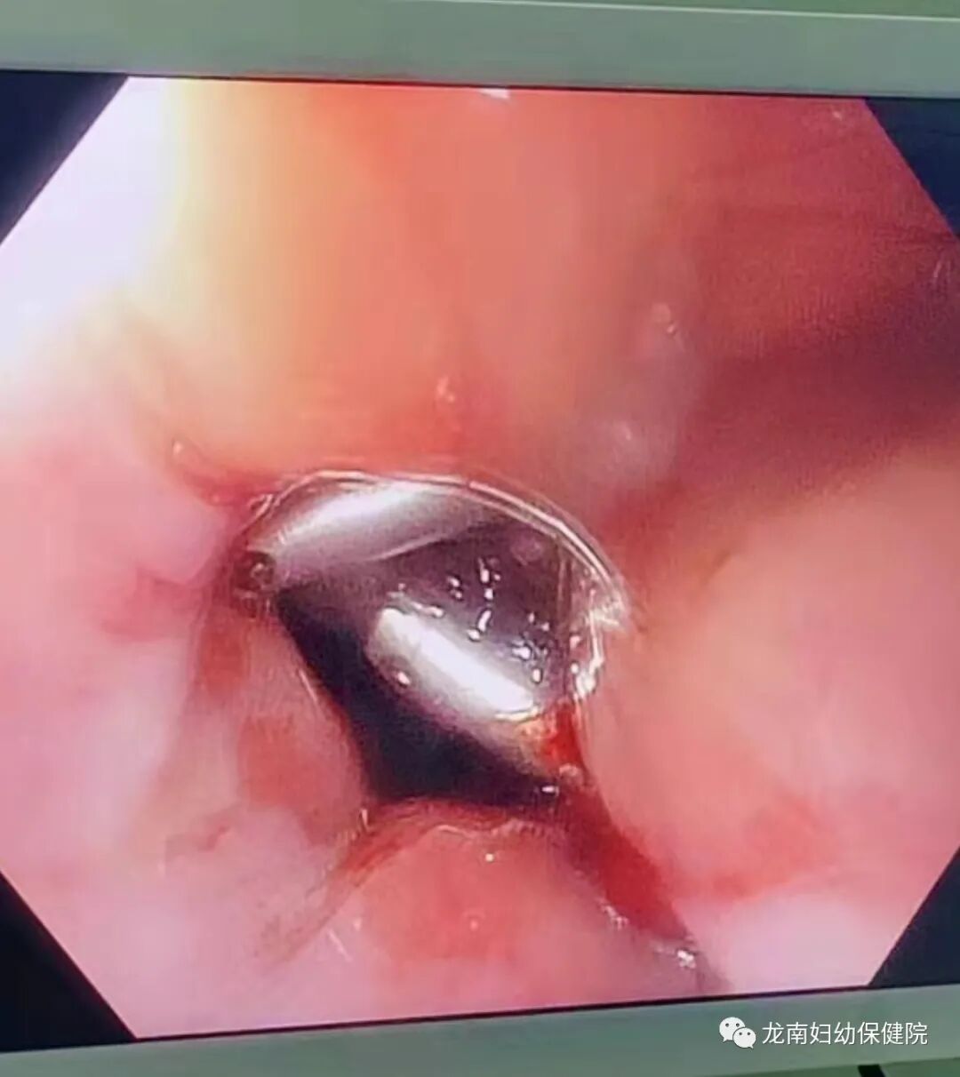 内镜夹怎么不掉【胃镜室病例】贲门出血“夹”然而止，消化内镜显神通_https://www.jmylbn.com_新闻资讯_第10张